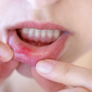 Mida teha, kui suhu tekkis vill? Apteeker jagab kasulikke nõuandeid