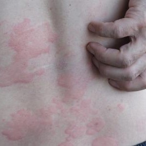 Apteeker: psoriaasi pole võimalik välja ravida, kuid sümptomeid saab ravimitega leevendada